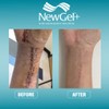 NewGel Advanced Silicone Professional Scar Treatment Tape by MyNewGel, Ultra-Thick,