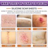 Silicone Scar Sheets,Silicone Scar Tape,Silicone Scar Removal Strips for Surgical,C-Section,Tummy