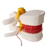 Human Herniated Disc Model, Anatomical Herniated Lumbar Vertebrae Disc Prolapse