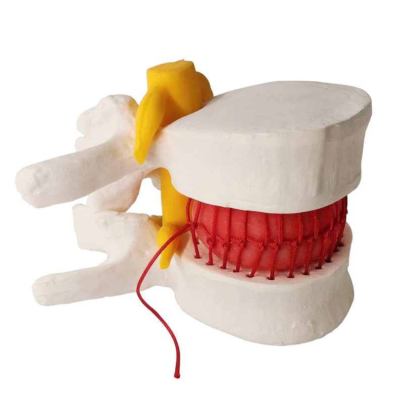 Human Herniated Disc Model, Anatomical Herniated Lumbar Vertebrae Disc Prolapse
