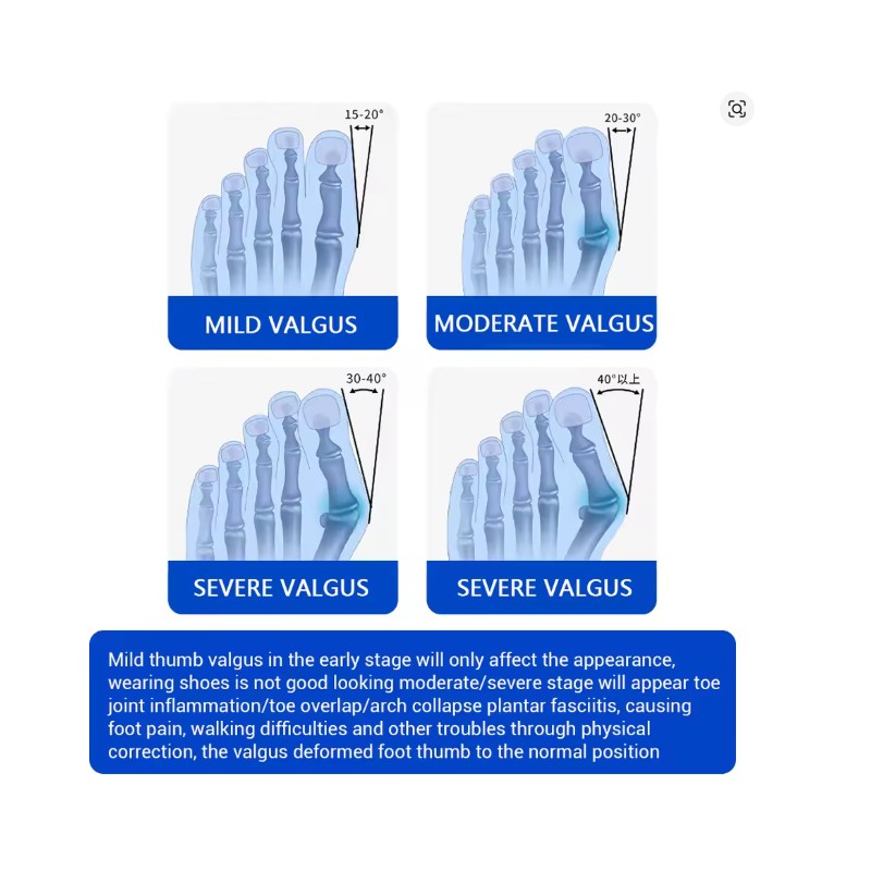 Bunion Corrector for Women Men Big Toe with Cold Compress