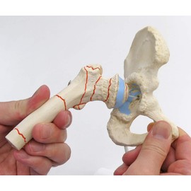 3B Scientific Human anatomy - thigh fracture and hip joint wear + free anatomy app - 3B Smart Anatomy