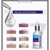 BIOAQUA Face Acne Treatment Scar Removal Spots Pimples Moisturizing Essential