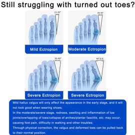 RWGKCDB Bunion Corrector, Big Toe Bunion Corrector for Men Women, Adjustable Knob Bunion Support Splint with Anti-Slip Heel Strap for Big Toe Bunion Relief (Color : Gray Black Buckle)