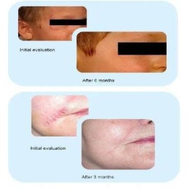 Crema Advanced Scar Formula Dermatix Ultra para todo tipo de piel de 15g