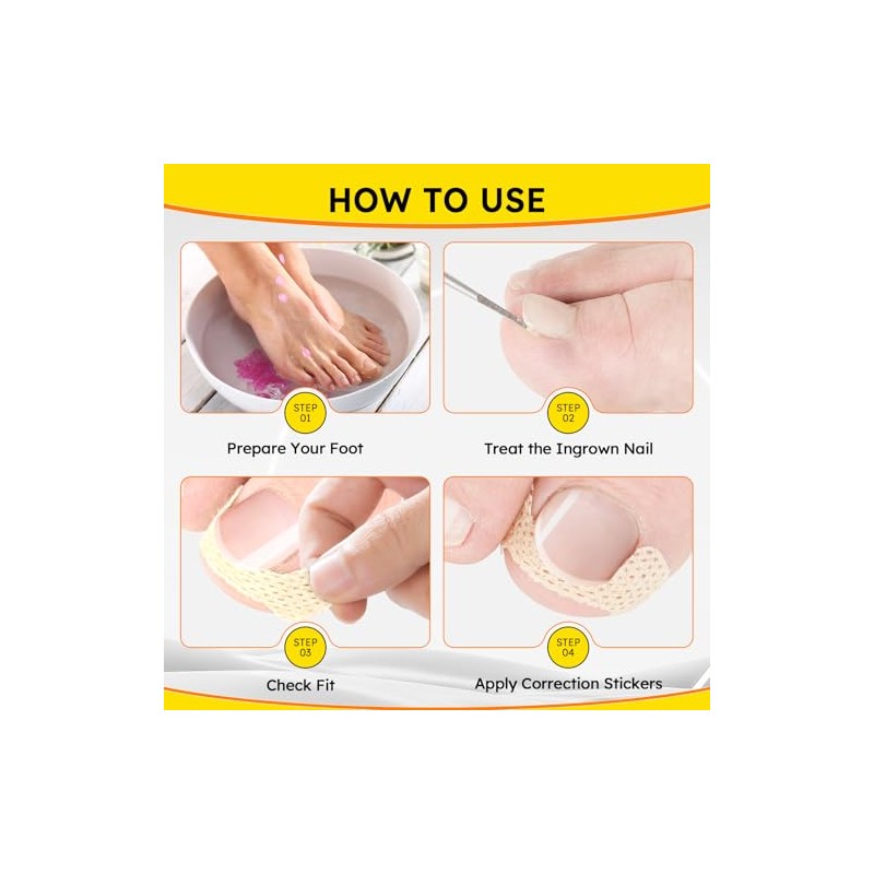 Tiras para uñas encarnadas, 60 unidades. Parche corrector de uñas
