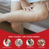 Leg Swelling Relief Cream – Edema Support Lotion for Tired,