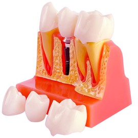 Dental Implant Model with Removable Crown Bridge - 4 Times Enlarged Demonstrative Teeth Model for Education and Study - Ideal for Class Demonstrations and Dental Student Training