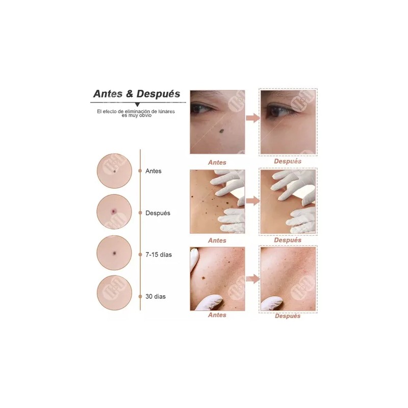 Eliminador Laser Plasma De Verrugas Genitales Vph Acne Full