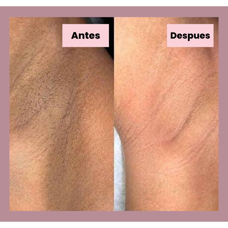 Generic Tonico Despigmentante LB *Elimina pecas, barros, paños, melasma*