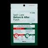 Veloa Skin Acne spot care before and after mole removal