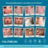 Tratamiento Para Acné Avanzado Neutralyze 2.0 90 Dias Import