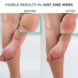 Hey Honey Walk the Walk Propolis Foot & Heel Cream for Dry, Cracked Feet | 72-Hour Hydration, Callus Remover & Odor-Fighting Moisturizer with Honey & Urea | 5 oz