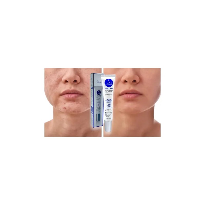 Crema Anti Acné Elimina Granos Espinillas Tratamiento 30g