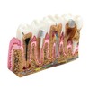 Dental Caries Tooth Anatomy Model Tooth Pathology Models Caries Evolution