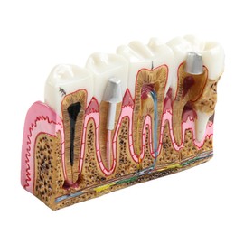 Dental Caries Tooth Anatomy Model Tooth Pathology Models Caries Evolution Model for Comprehensive Structure Teaching and Oral Study