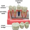 Windplusya Dental Implant Model 4 Times Implant Teeth Model, Analysis