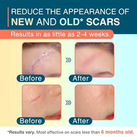 Silicone Scar Sheets, 1.55” x 156” - 4M, Medical Silicone Scar Tape Roll, Reusable Scar Strips for Surgical, C-Section, Keloid Bump, Stretch Marks, Acne, Hypertrophic Scar Treatment