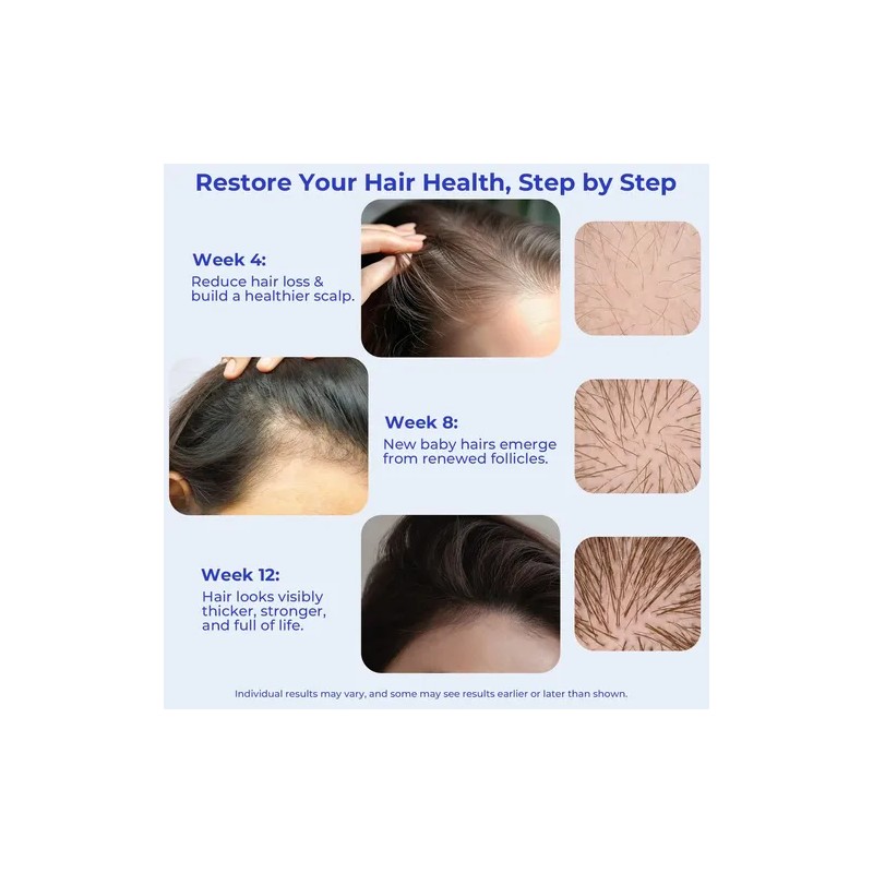 Serum Para El Crecimiento Del Cabello Eoiroa Con 3% De
