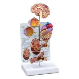 GPI Anatomicals - Hypertension Model Set, Replica for Human Anatomy and Physiology Education, Anatomy Model for Doctor's Offices and Classrooms, Medical Learning Resources