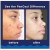 PanOxyl Acne Foaming Wash Benzoyl Peroxide 10% Maximum Strength Antimicrobial,