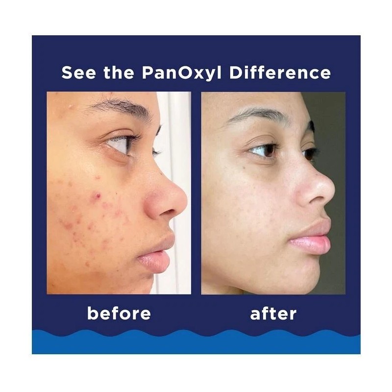 PanOxyl Acne Foaming Wash Benzoyl Peroxide 10% Maximum Strength Antimicrobial,