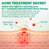 Pickelmale Entfernen, Pickelentferner, Blue Light Acne Treatment, Blaulicht Akne Entferner,