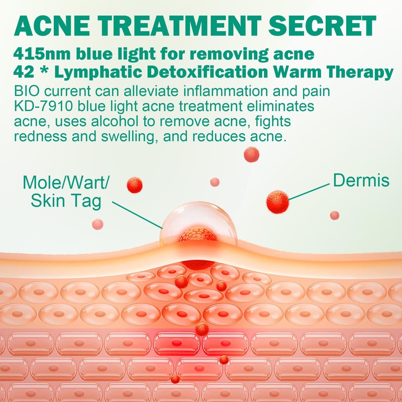 Pickelmale Entfernen, Pickelentferner, Blue Light Acne Treatment, Blaulicht Akne Entferner,