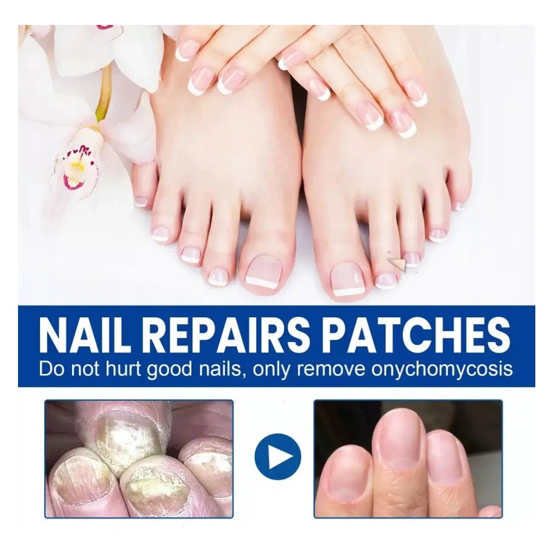 60 Parches Reparación De Uñas Nails Hongos