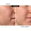 ExfoliKate® Intensive Exfoliating Treatment, 0.5 Fl. Oz.