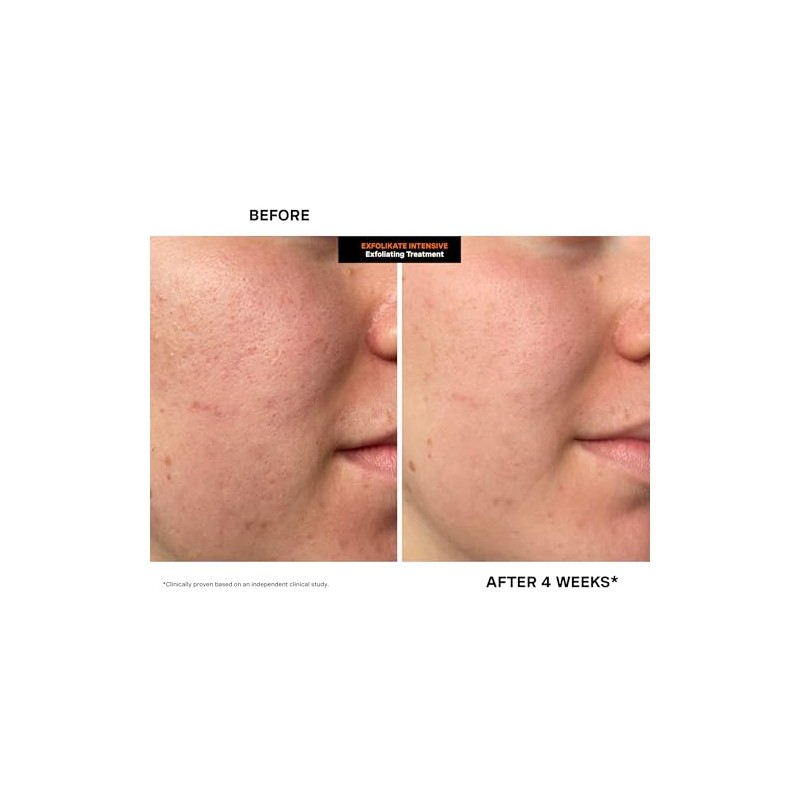 ExfoliKate® Intensive Exfoliating Treatment, 0.5 Fl. Oz.
