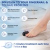 iKeener iKeener Nail Fungus Laser Therapy Device,Nail Laser Cleaning for