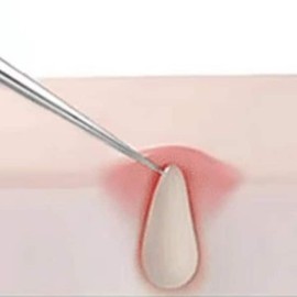 뾰족피지핀셋 초등학생블랙헤드 귀블랙헤드제거 겨드랑이피지제거 Sharp Pimple Tweezers for Elementary School Students, Ear Blackhead Removal, Underarm Sebum Removal