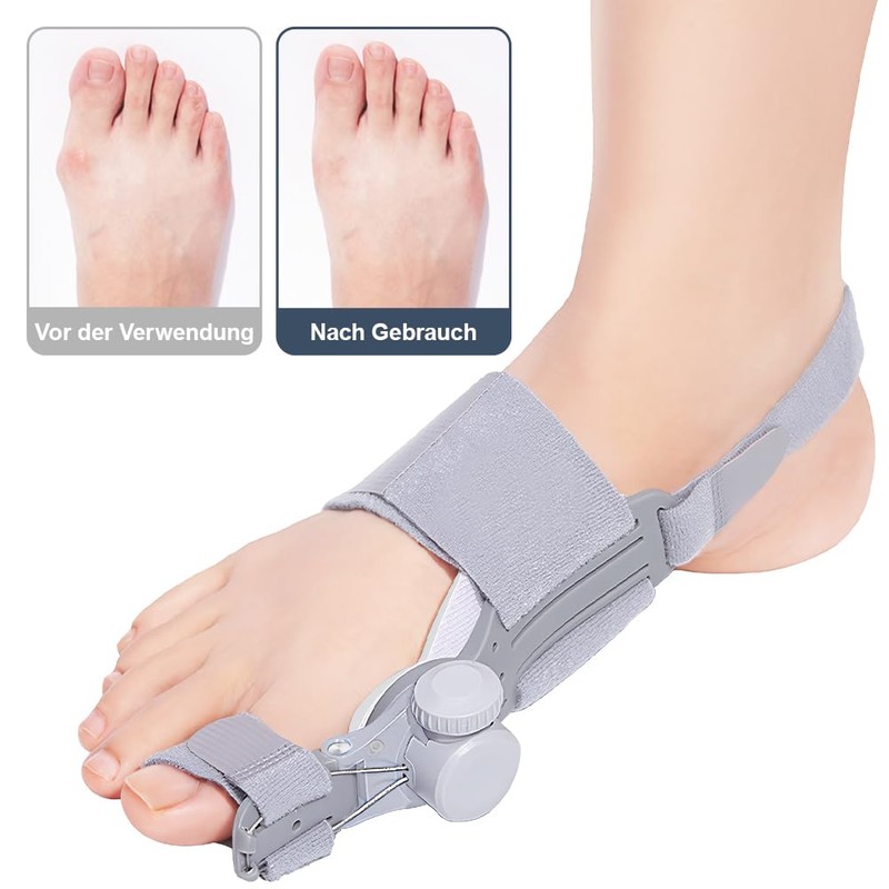 RDTOK Hallux Valgus Correction (Left Foot)