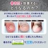 Winding Nail Clip, Intrapeze, Makizume, Winding Nail Correction, Dr Nail