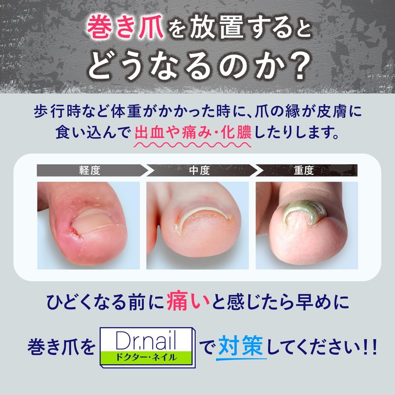 Winding Nail Clip, Intrapeze, Makizume, Winding Nail Correction, Dr Nail
