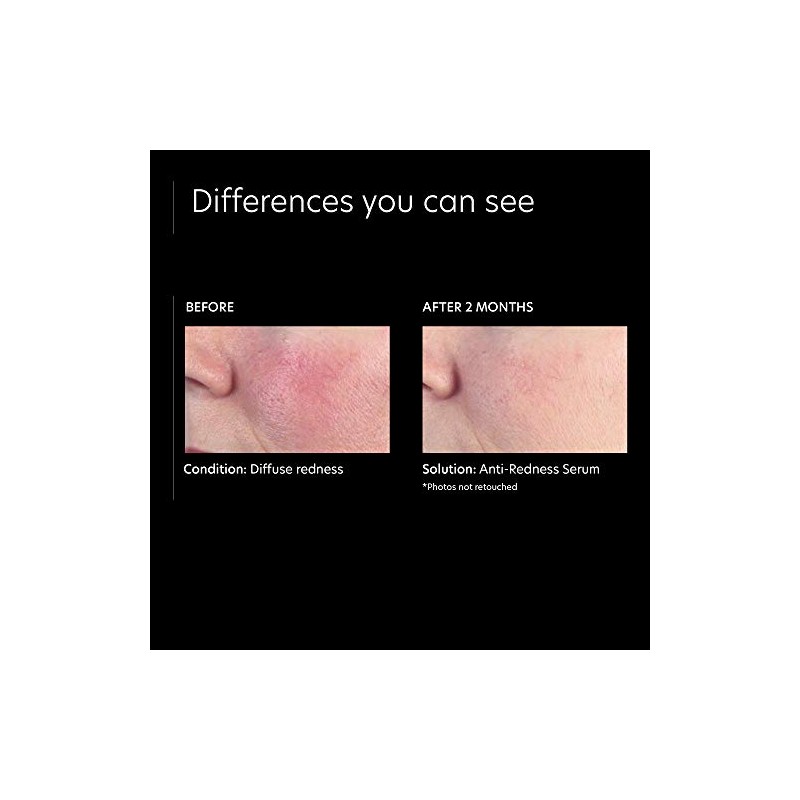PCA SKIN Anti-Redness Serum, 1 fl. oz.