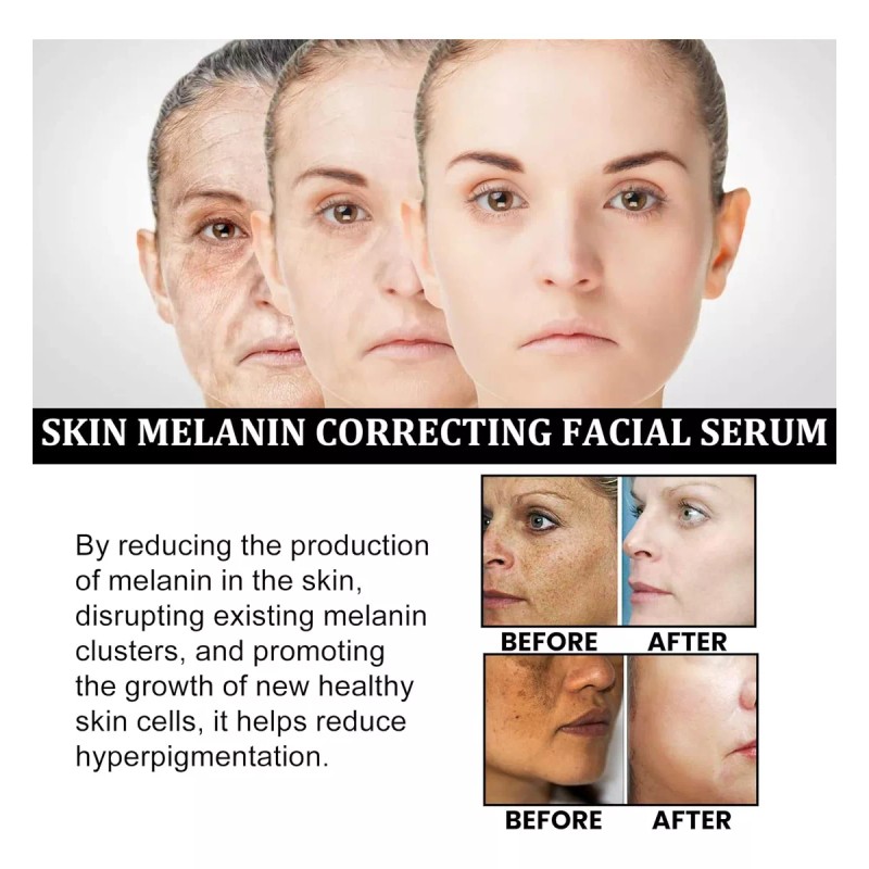 Deuiosna 2023 Corrección De Melanina Suero Facial, Sero De Cara
