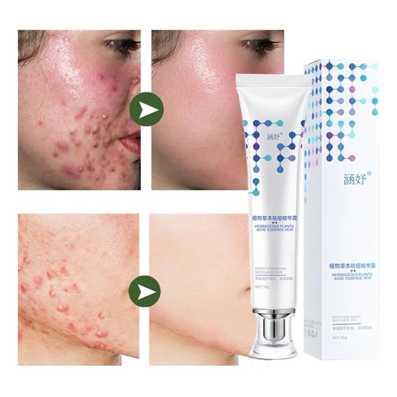 Gel Acné, Antiacné Tratamiento Herbolario Cuidado De La Piel