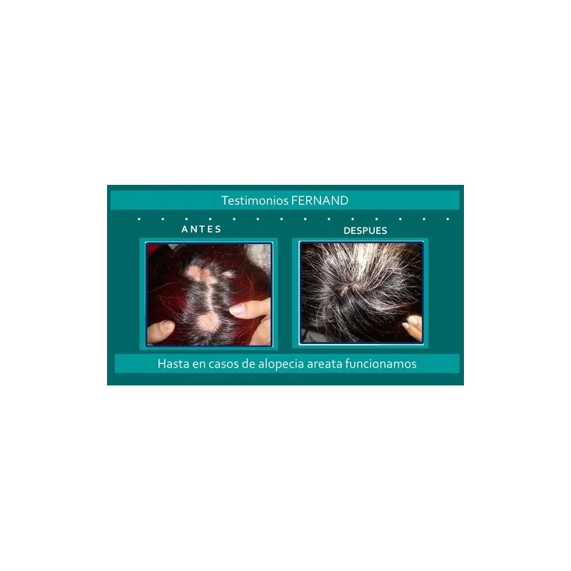 Solución Anticaida Para Mujer Con Cabello Con Caspa