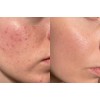 Serum Antiacné Láctico 5% + Crema Facial Hialuronico Acneica Noche