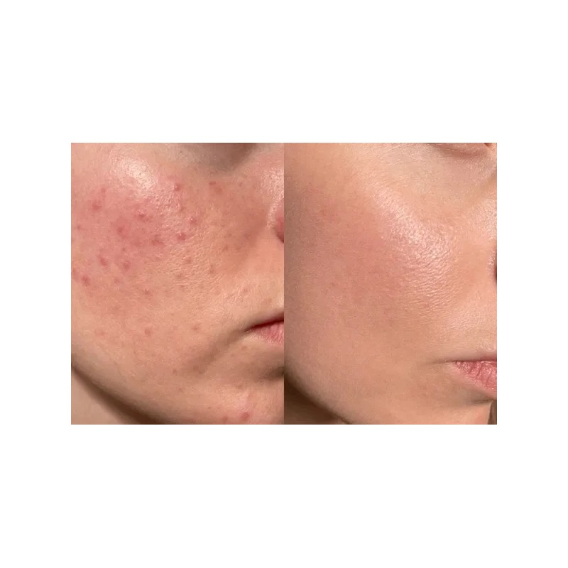 Serum Antiacné Láctico 5% + Crema Facial Hialuronico Acneica Noche