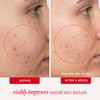 First Aid Beauty Acne Pads for Face - Maximum Strength
