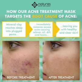 Natural Clear Acne Treatment Facial Mask – Works Better Than Benzoyl Peroxide And Salicylic Acid to Clear Acne Spots, Zits, Blemishes And Remove Blackheads And Gunk From Deep In The Pores-All Natural