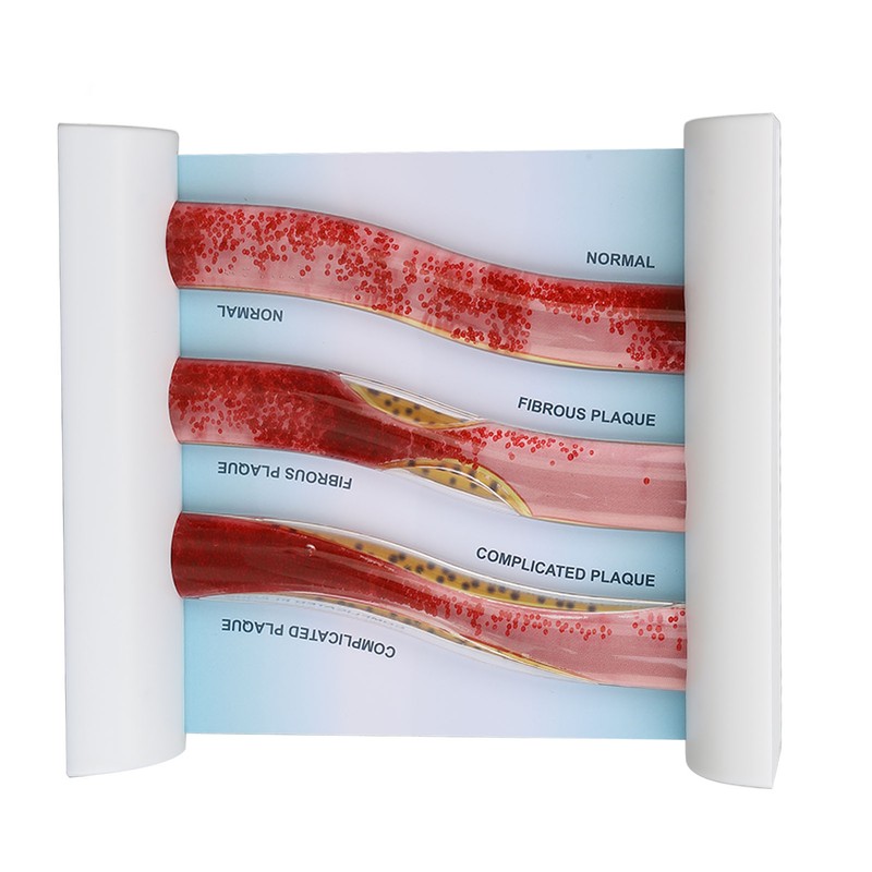 Lipoprotein LDL Blood Vessel Model Low Density Blood Lipid Vessel