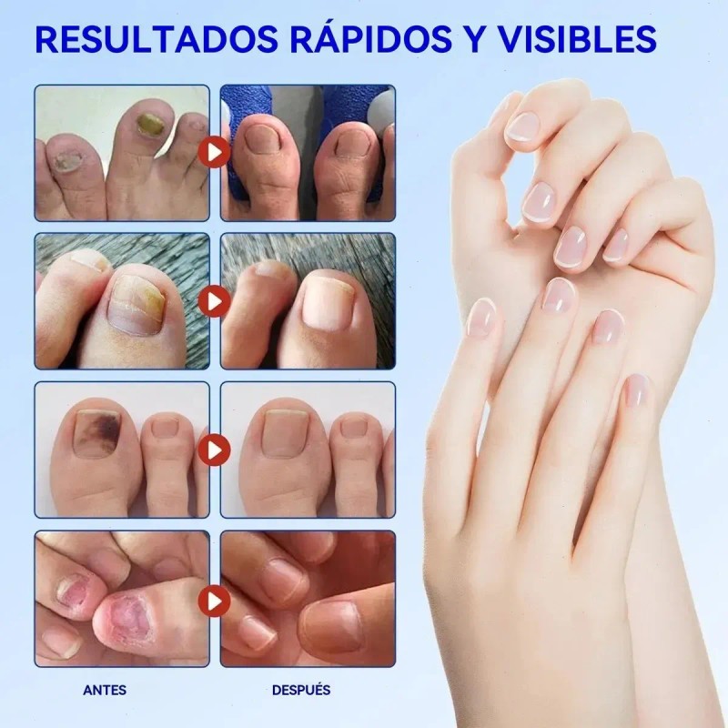 Ácido Salicílico Naíma 50g Cuidado Facial Mixta Exfoliante Antiacné Sin