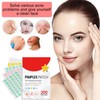 200pcs Hydrocolloid Acne Patches,Acne Patch Pimple Patch,Hydrocolloid Patches for Pimples,