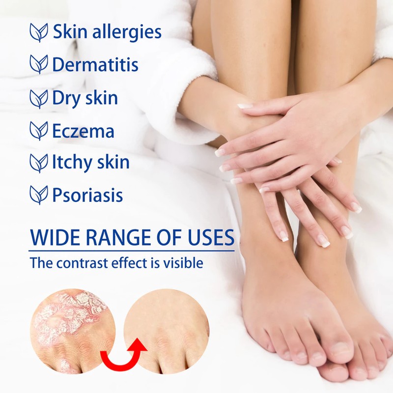 Ubat gatal kulit Cream gatal 止癢膏 20g skin Antibacterial skin