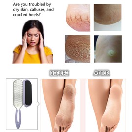 YIOYOODA 3-in-1 Foot File Callus Remover for Feet, Large Double Sided Foot Scraper Stainless Steel Pedicure Rasp Foot Scrubber with Sand Paper Debris Catcher for Dead Cracked Skin, Wet & Dry Use