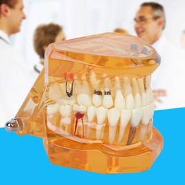 FTVOGUE Enfermedad Dental de Color Naranja Estudio de demostración extraíble Modelo de Dientes de enseñanza para Dentista y Escuela